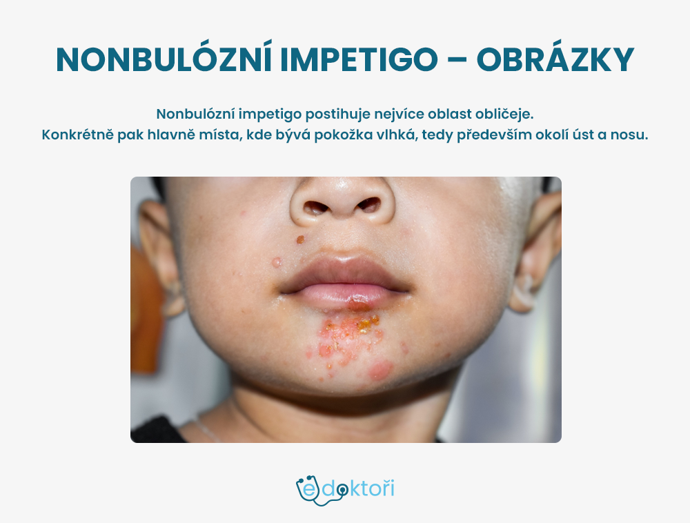 Nonbulózní impetigo