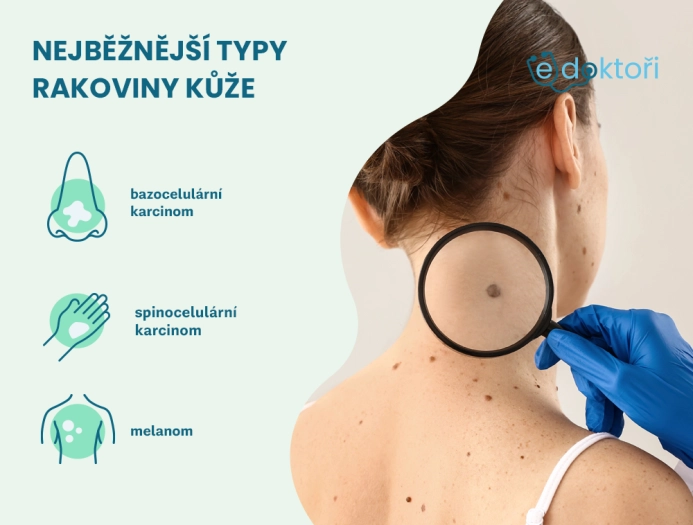 Rakovina kůže