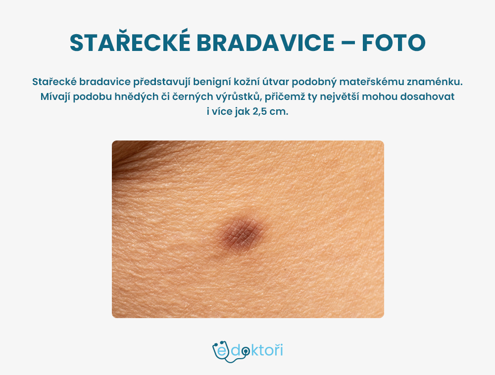stařecké bradavice foto