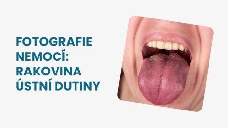 Foto rakovina ústní dutiny