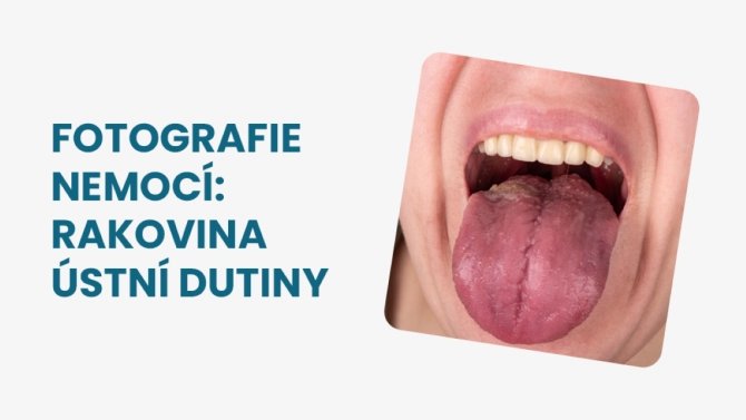 Foto rakovina ústní dutiny