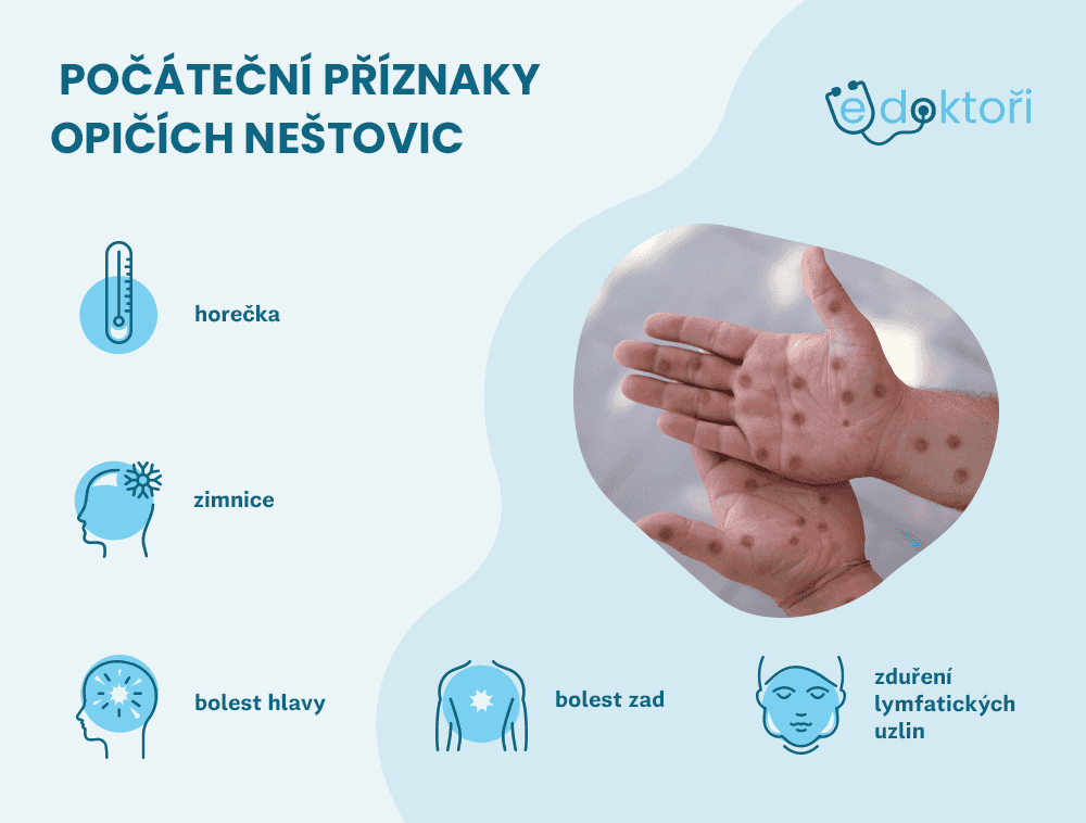 Autor: Redakce edoktori.cz příznaky opičích neštovic