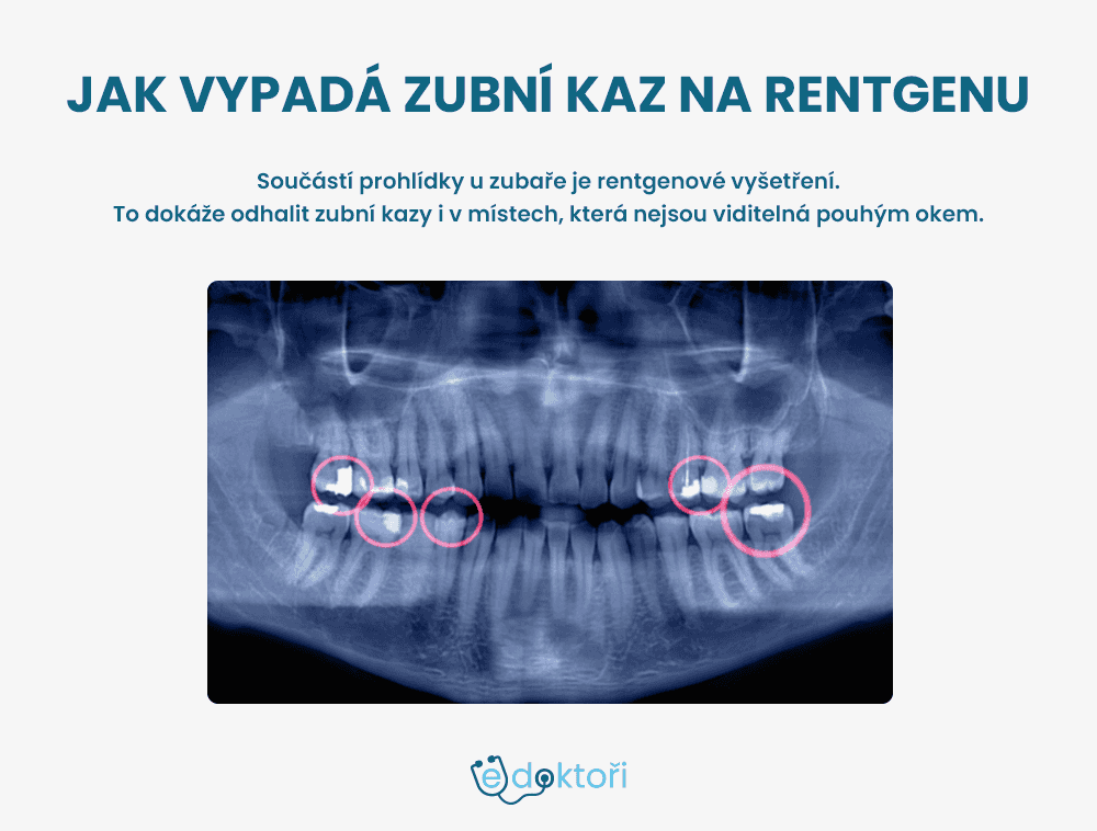 Zubní kaz na rentgenu - obrázky