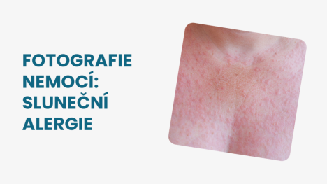sluneční alergie foto