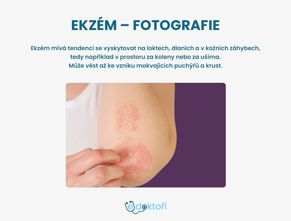 Ekzém na ruce