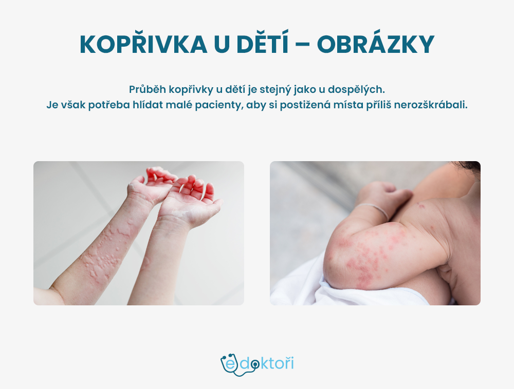 Kopřivka u dět obrázky