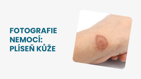 plíseň kůže foto