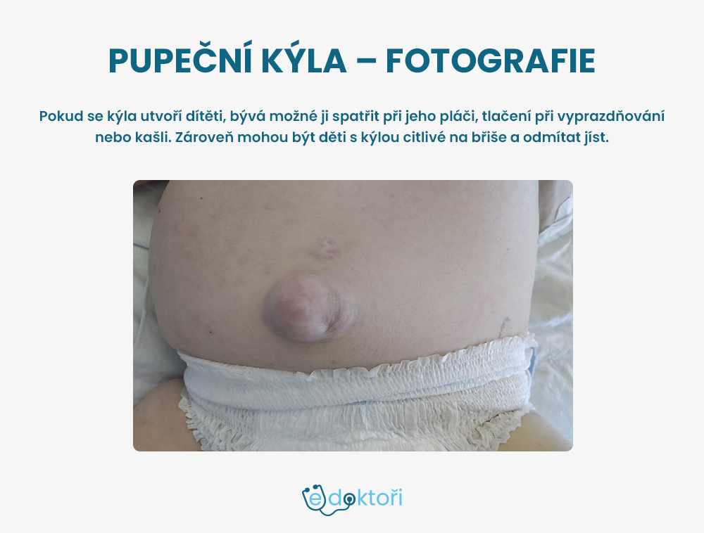 Pupeční kýla u novorozence