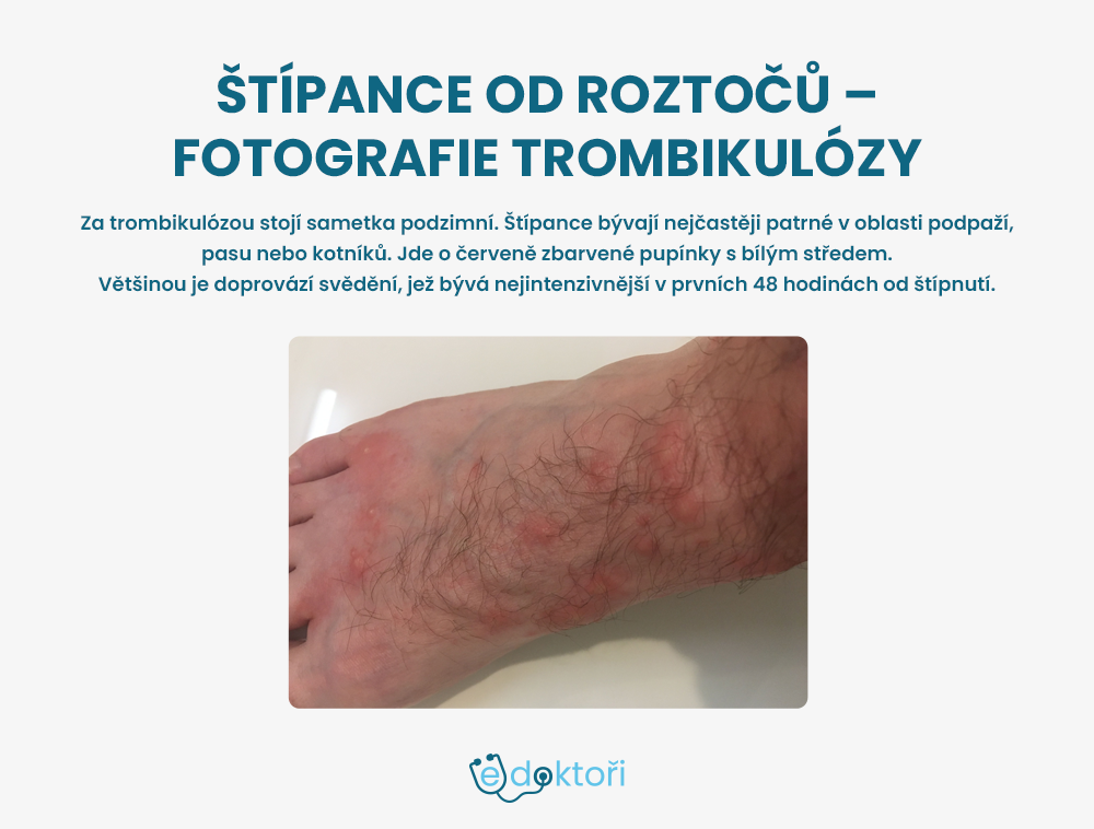 štípance od roztočů - trombikulóza
