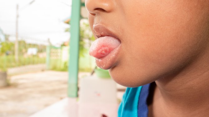 Syndrom ruka, noha, ústa diskuze