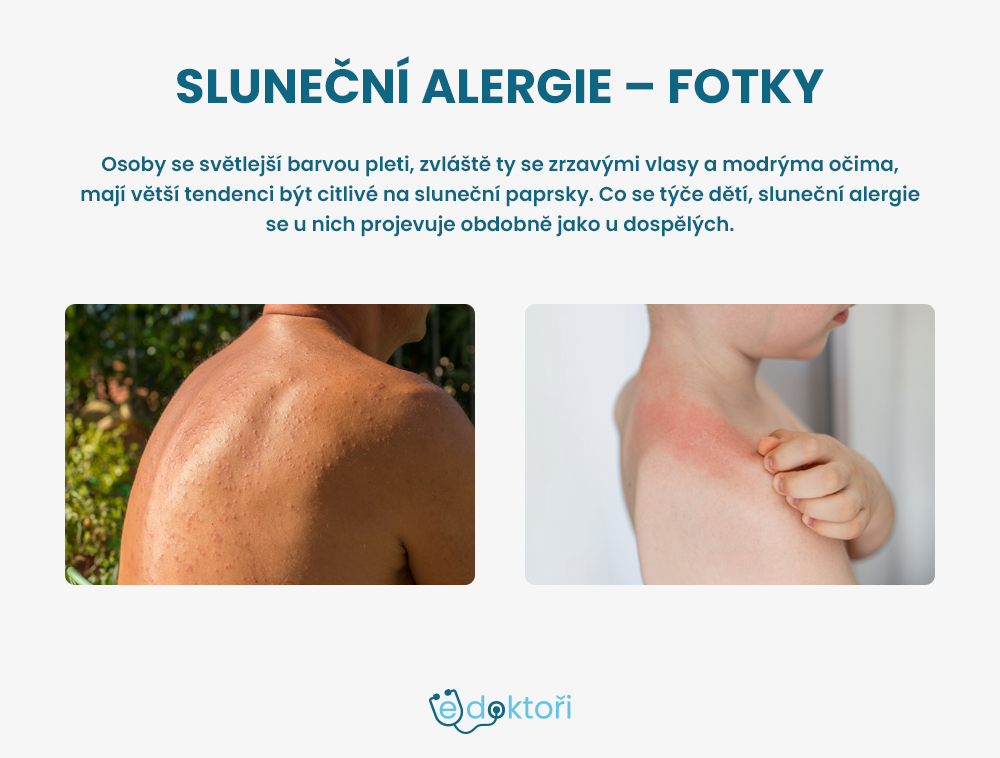 sluneční alergie foto