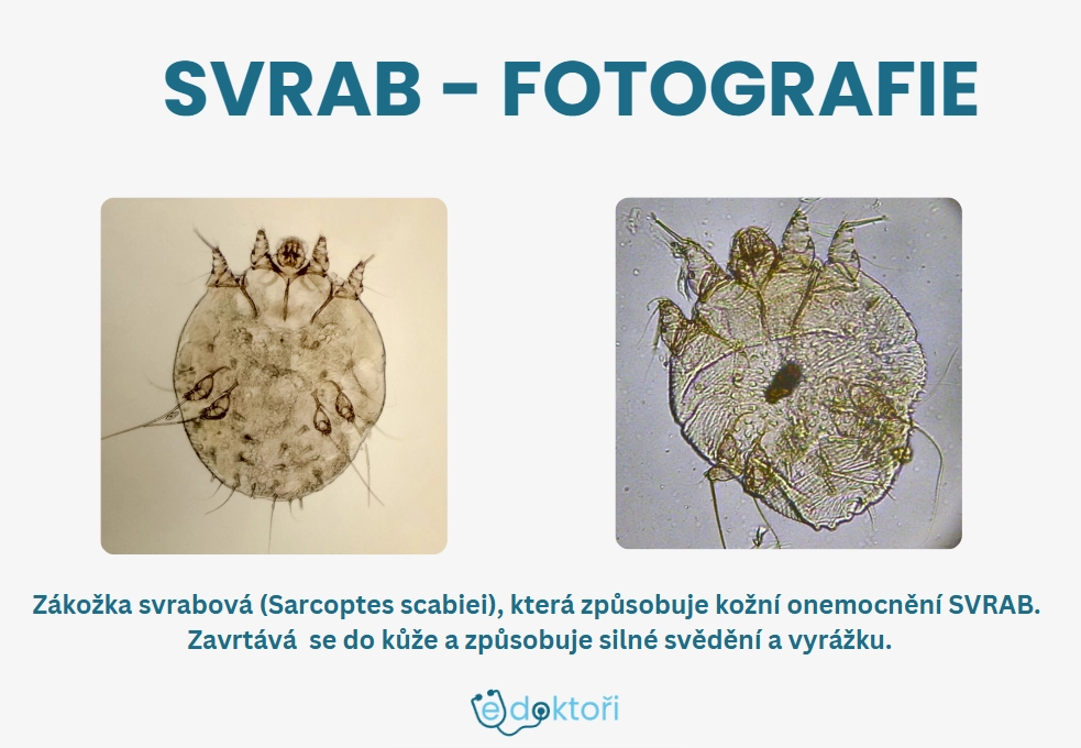 svrab obrázky - zákožka svrabová