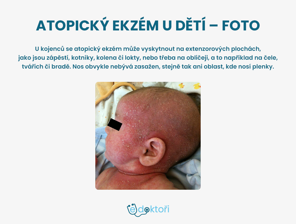Atopický ekzém u dětí - foto