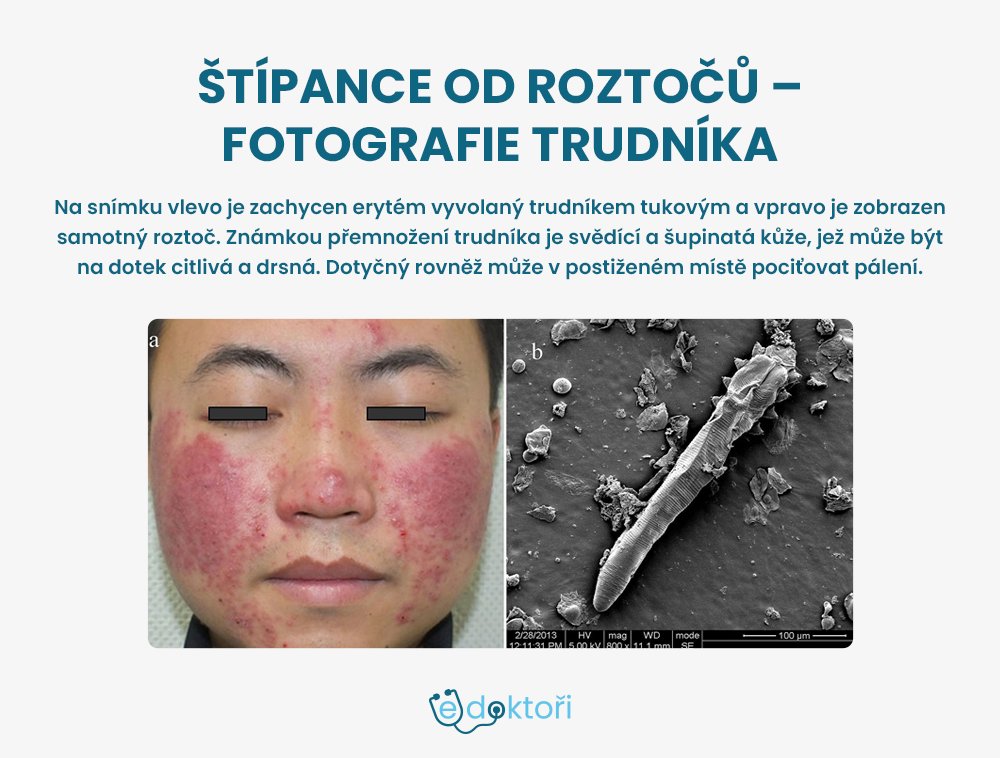 štípance od roztočů foto - trudník