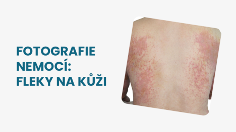 Fleky na kůži na zádech
