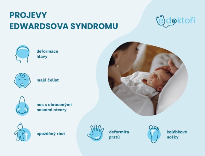 Příznaky Edwardsova syndromu