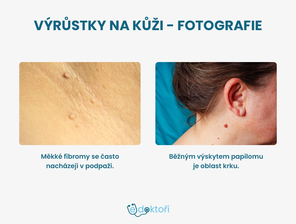 Fibrom a papilom