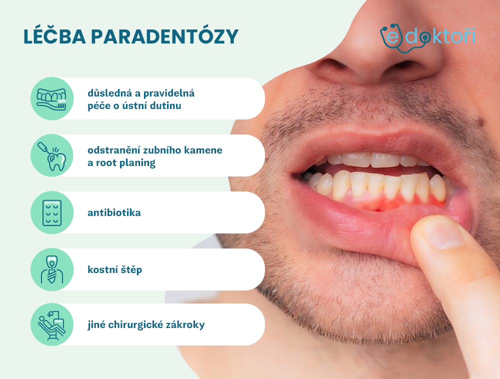 léčba paradentózy