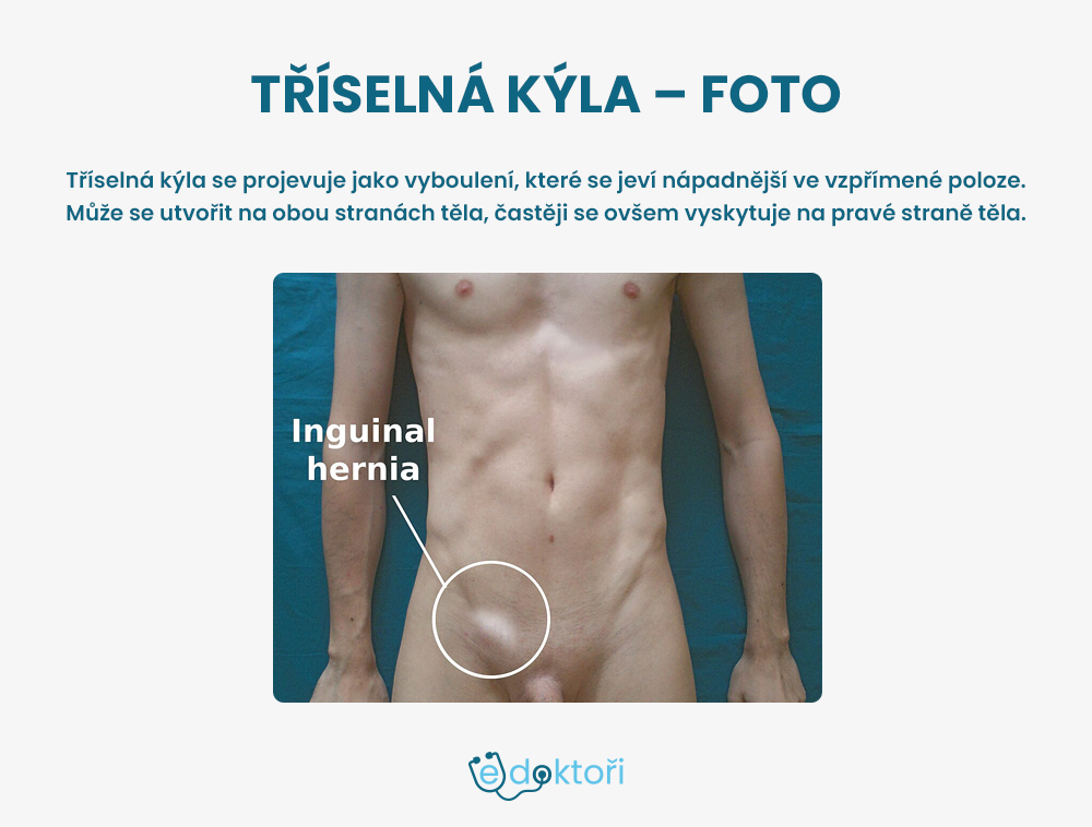 tříselná kýla foto
