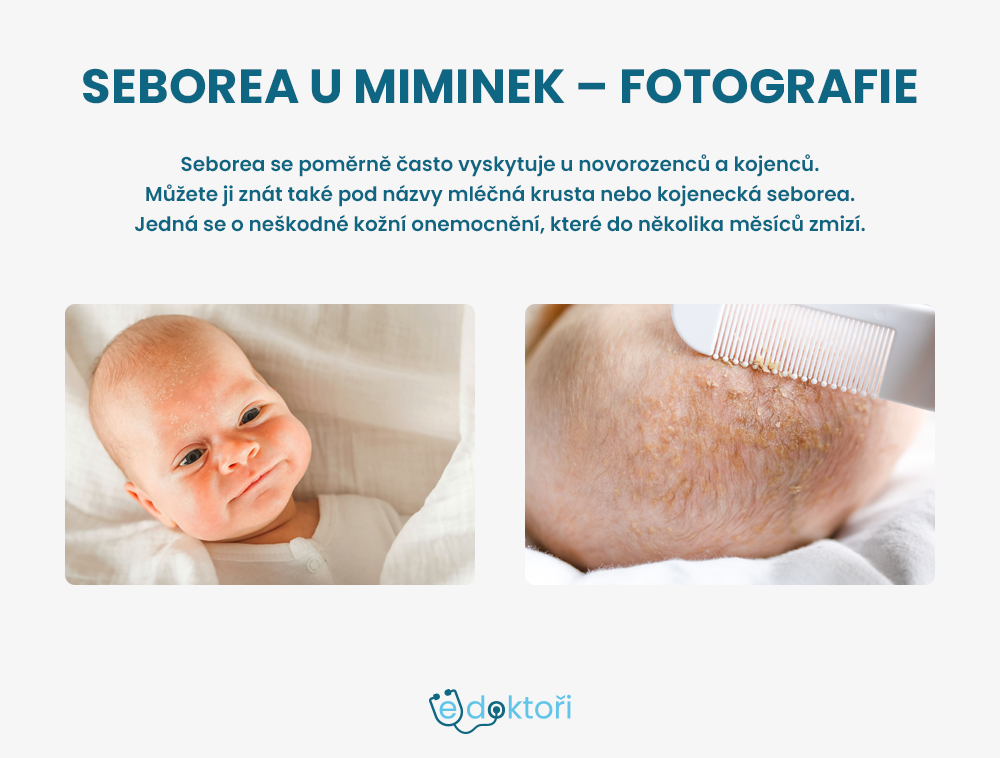 Seborea u miminka obrázky