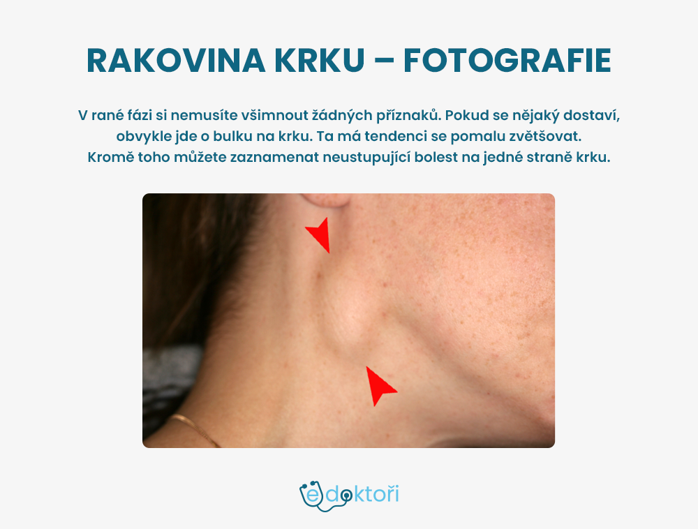 Rakovina krku - fotografie bulky na krku
