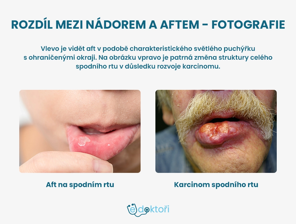 Rozdíl mezi nádorem a aftem foto