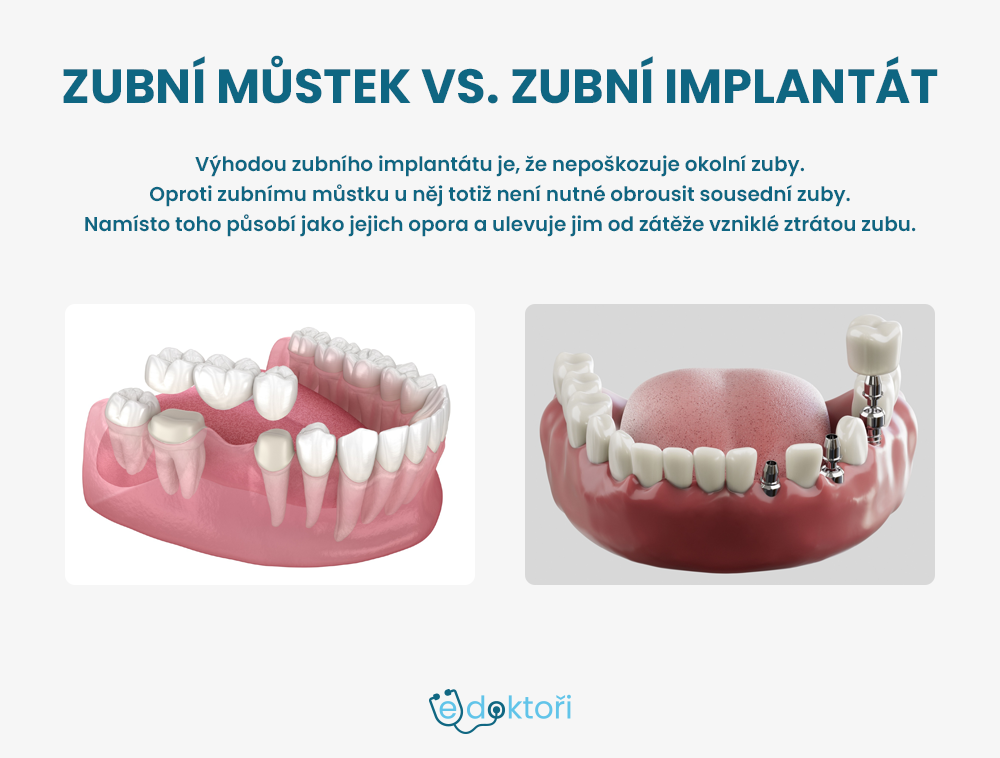 Zubní můstek a zubní implantát fotografie
