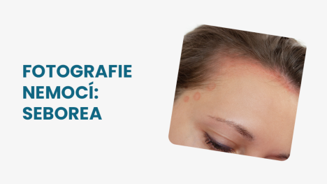 Seborea fotografie