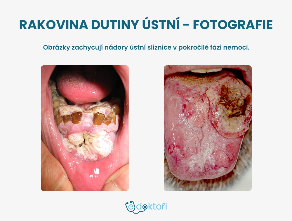 Rakovina dutiny ústní obrázky