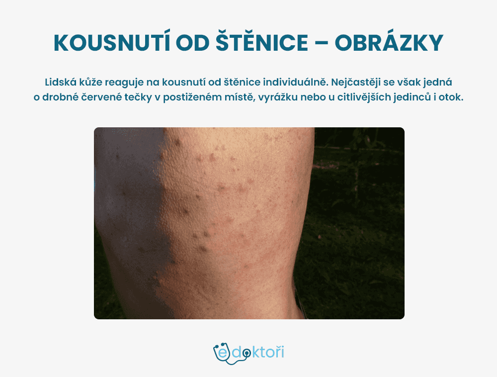 Kousnutí od štěnice - obrázky