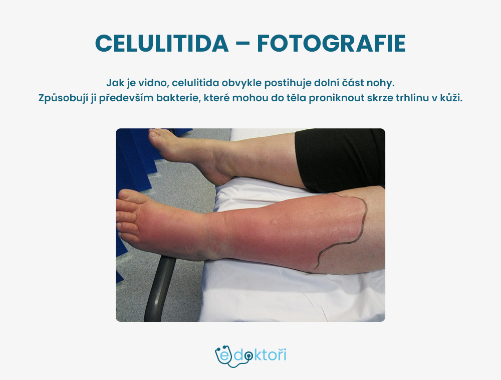 Celulitida fotografie