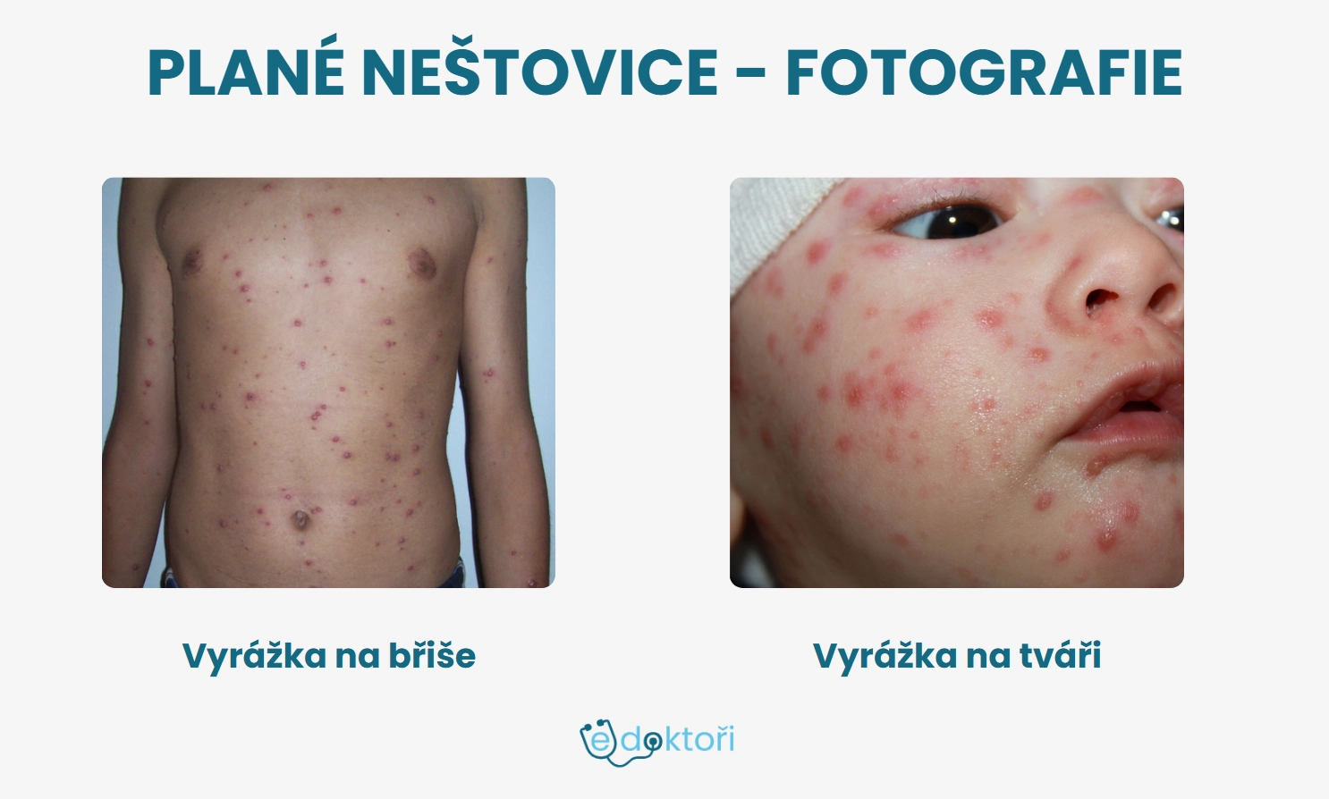 Neštovice u dětí
