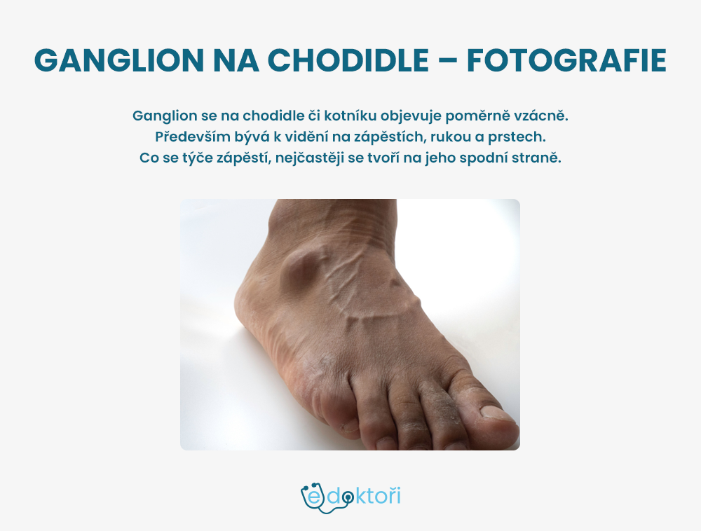 ganglion na chodidle - fotografie
