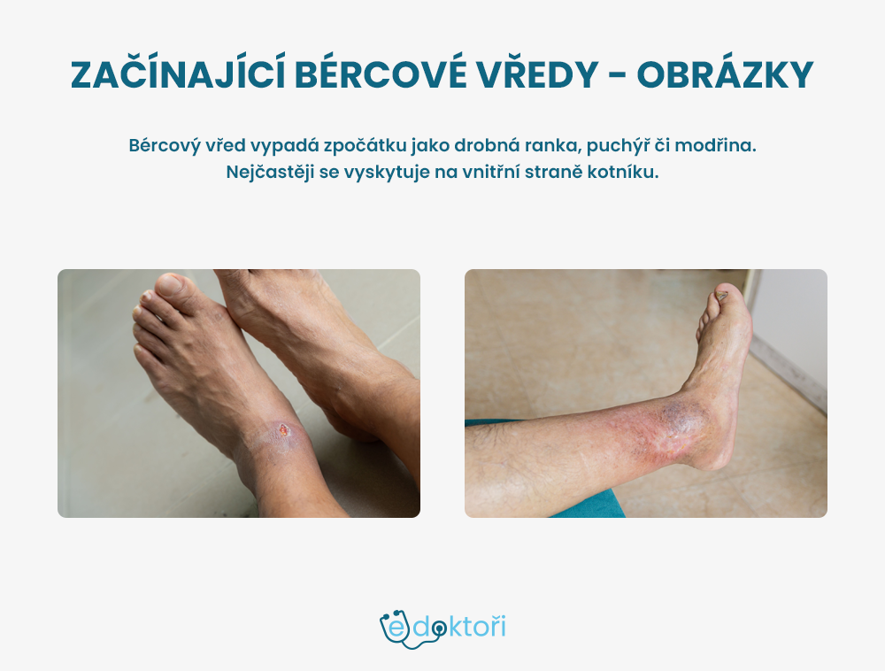 Náběh na bércové vředy