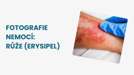 Růže erysipel