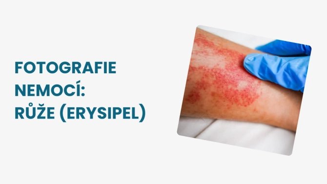 Růže erysipel