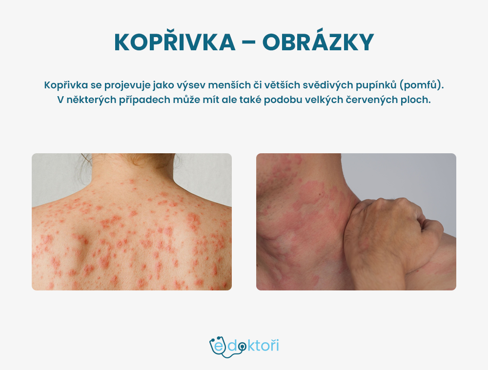 Kopřivka obrázky