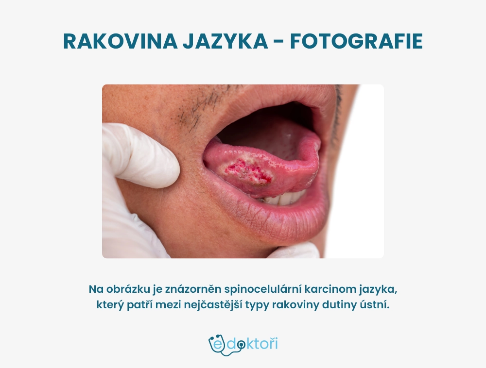 Rakovina jazyka fotografie