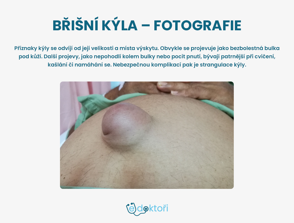 Břišní kýla fotografie