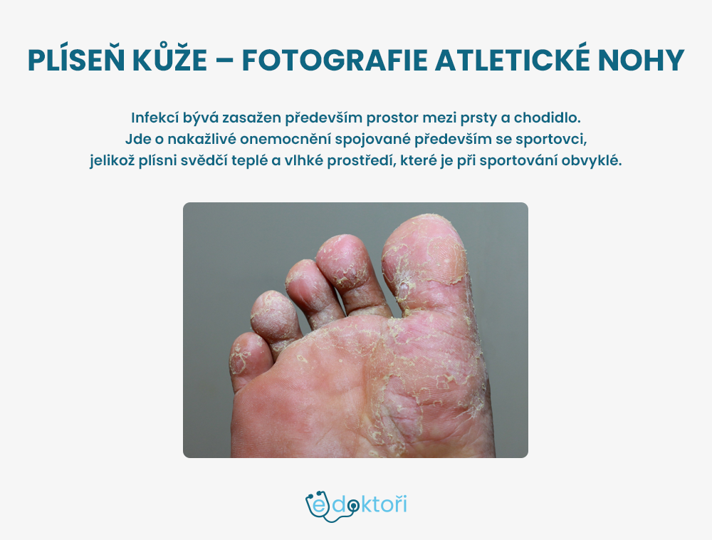 atletická noha foto