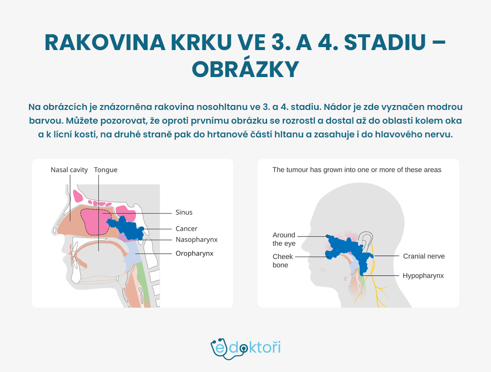 Rakovina krku - obrázky 3. a 4. stadia