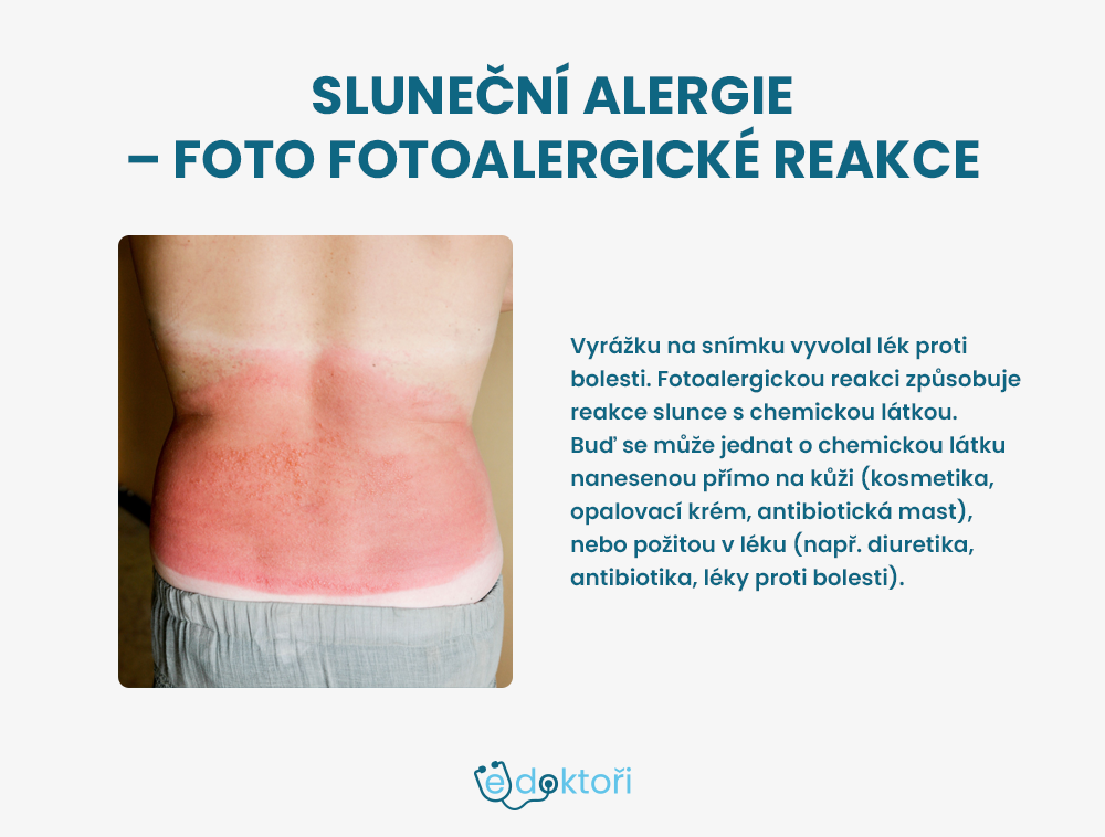 sluneční alergie fotky - fotoalergická reakce