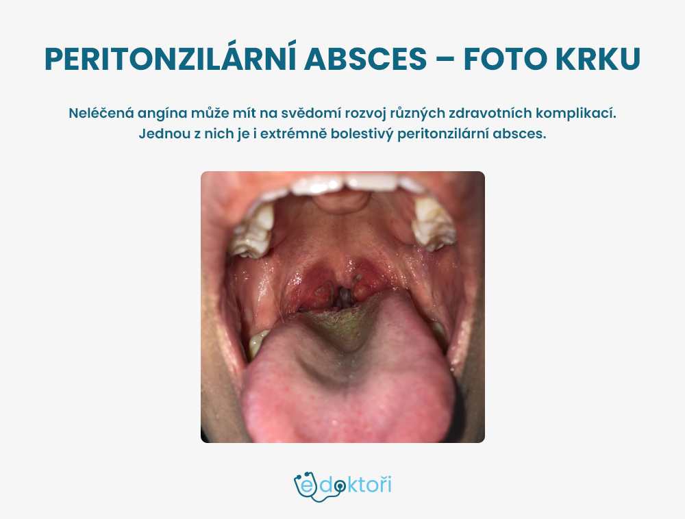 Peritonzilární absces