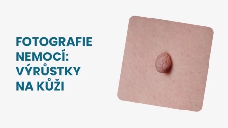 Výrůstky na kůži foto