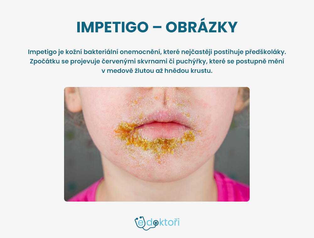 Impetigo