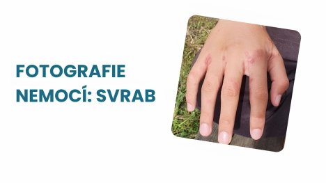 Svrab obrázky