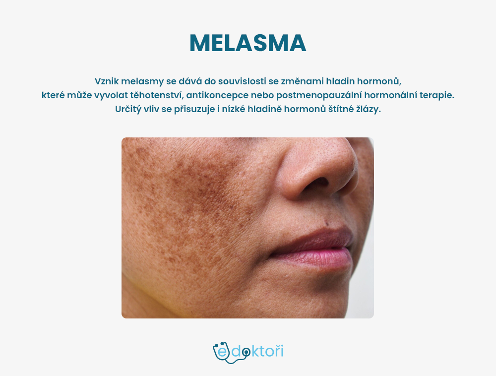 Melasma fotografie