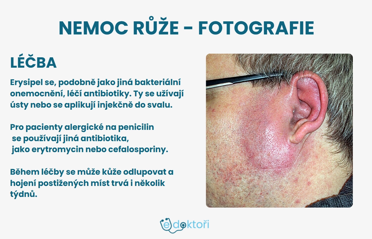 Růže nemoc léčba