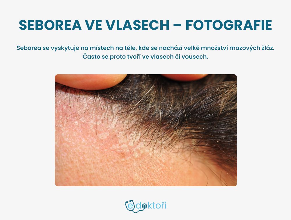 Seborea ve vlasech obrázky