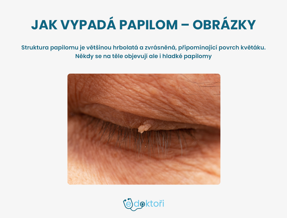 Jak vypadá papilom - obrázky